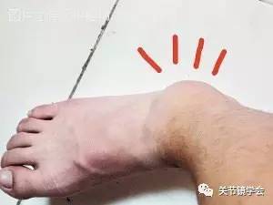 打球膝盖会受什么轻伤
