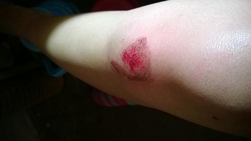 打完乒乓球腿疼怎么恢复